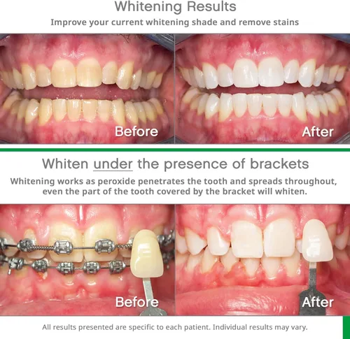Vista 3 de Opalescence GO 15% (10 tratamientos) Bandejas blanqueadoras de dientes originales precargadas con pasta de dientes blanqueadora de viaje, 1.0 onzas