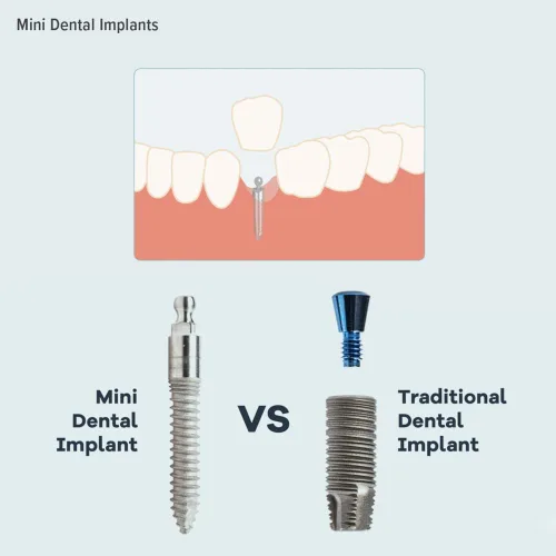 Vista 7 de Junta tórica, Buna-n, kit de herramientas con 3 tamaños convenientes, reemplazo para mini implantes dentales