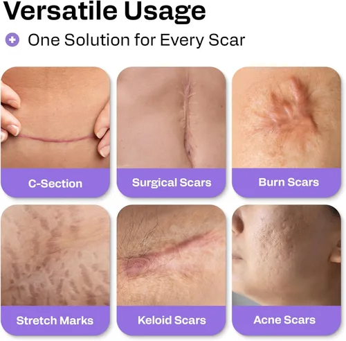 Vista 6 de AWD Rollo de cinta de silicona para cicatrices de 60 pulgadas – cinta de cicatrices de grado médico para cicatrices quirúrgicas, cesárea