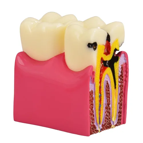 Ultrassist Modelo de caries dental, modelo de demostración de caries dental, modelo de enseñanza de anatomía dental para educación dental,