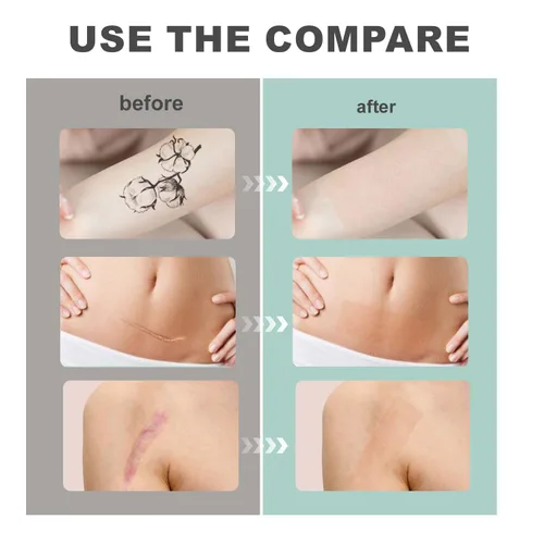 Vista 6 de Hojas de silicona para cicatrices, tiras de cinta de silicona para cicatrices quirúrgicas, cesáreas, abdominoplastia, cicatrices queloides