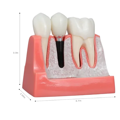 Vista 5 de ANNWAN Modelo de implante dental 4 veces análisis extraíble Puente de corona Demostración Modelo de dientes para educación de clase y estudio