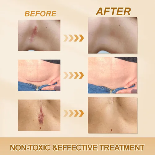 Vista 5 de Hojas de silicona para cicatrices, cinta de silicona para cicatrices, hojas de silicona para cicatrices (rollo de 1.6 x 59 pulgadas - 4.9 ft) sin