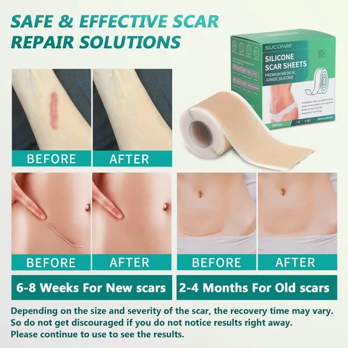 Vista 3 de Cinta de silicona para cicatrices quirúrgicas (rollo de 1.6 x 80 pulgadas, 6.6 ft), láminas de silicona de grado médico para cesáreas