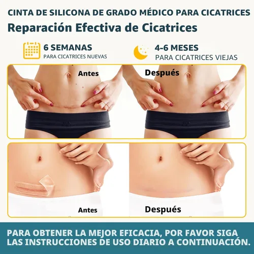 Vista 3 de Cinta de silicona para cicatrices, rollo de 60 x 1.6 pulgadas, 4.9 ft, tratamiento de cicatrices para mejorar cicatrices quirúrgicas, queloides